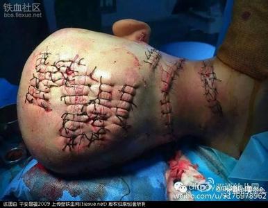 河南5岁男童被继母砍50多刀 右手手指被砍断